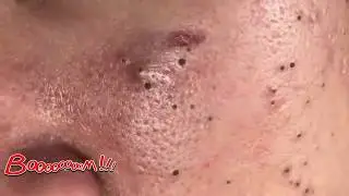 ПРЫЩИ и угри ВЫДАВЛИВАНИЕ новое