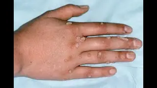 5 mënyra për t’i hequr qafe lythat përgjithmonë