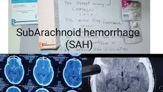 Sub Arachnoid Hemorrhage (SAH) proper managment