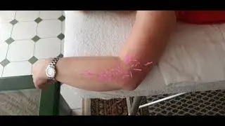 Боль в локте. Наружный эпикондилит.