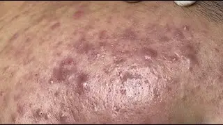 Acne treatment for Hoang (P.3)  #HoangMySpa113