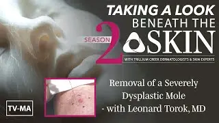 Beneath the Skin - Removal of a Severely Dysplastic Mole