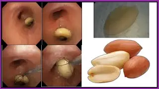 Paediatric Foreign Body Removal Of Nut ! শিশুর ফুসফুস থেকে বাদাম বের হল #BD_ENDOSCOPY