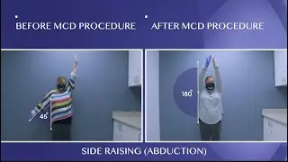 Cured Months Of Frozen Shoulder Pain!