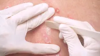 Toolkit Dermatologie: Einsatz des  Holzspatel
