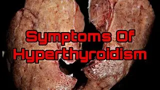 Symptoms Of Hyperthyroidism|Knowledge Madnoob