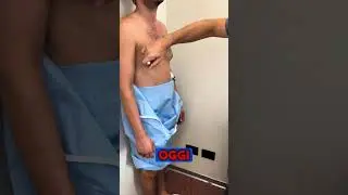 Visita Preoperatoria per Ginecomastia: Le marcazioni