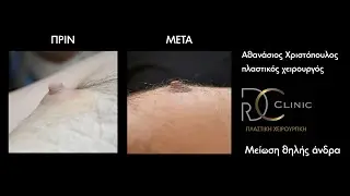Μείωση θηλής σε άνδρα με LASER