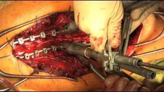 Correction of Scoliosis Using Differential Rod Contouring and Direct Vertebral Rotation