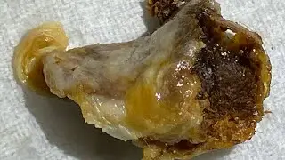 1,584 - Huge Plug of Ear Wax Extracted using the Rai Ear Pick!