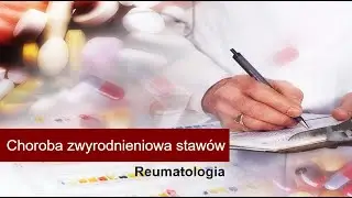 Choroba zwyrodnieniowa stawów - przyczyny, leczenie, diagnostyka, rokowanie