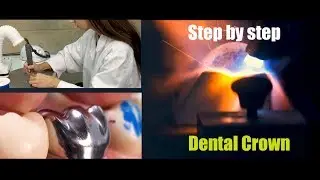 Investment casting of a dental metallic crown. Lost wax technique from impression to fabrication.