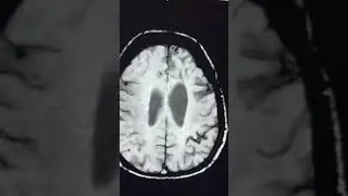 Significance of SWI - Superficial siderosis