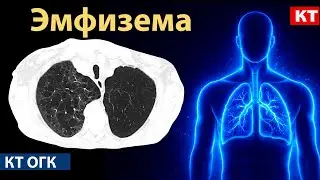 Лучевая диагностика эмфиземы легких