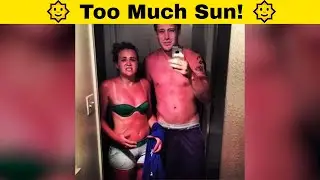 Funny Sunburn Fails That Made People Regret Not Using Lotion! 🌞