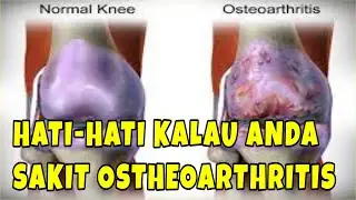 SERING SAKIT LUTUT? AWAS OSTHEOARTHRITIS | herbal alami untuk ostheoarthritis nyeri lutut