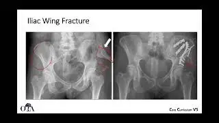 Introduction to orthopaedic trauma for OR staff - 3 of 3