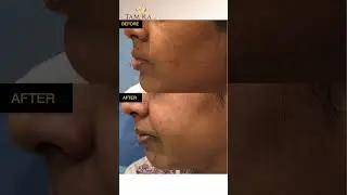 #glutathione