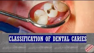 Classification of Dental Caries