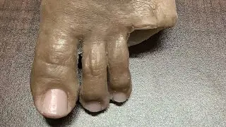 Silicone Foot Prosthesis - Cosmetic Restoration