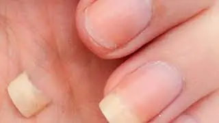 Ломкие ногти что делать