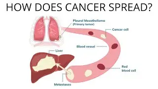 केंसर कैसे फैलता है? How does cancer spread? 