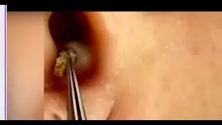 **SUPER SATISFYING** EAR BLACKHEAD REMOVAL #shorts