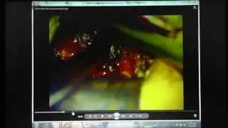 Lumbar Decompression Surgery Techniques and Tools