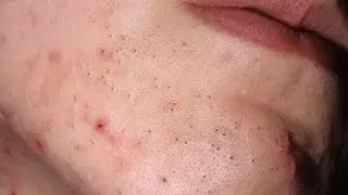 Маска для черных точек сух