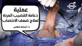 عملية دعامة القضيب المرنة لعلاج ضعف الانتصاب |  الدكتور اسامة غطاس