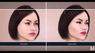 Бихэктомия (удаление жира из щёк) - Щёки Нефертити - Как это работает? Доктор Гунцель Озтурк