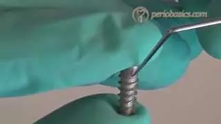 Components of a dental implant