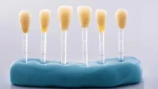 FAQ - What is a veneer? | Jacksonville Dental Specialists
