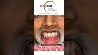 Broken Front Tooth? Watch this now! Dr. Srishti Bhatia #smilemakeover #smile
