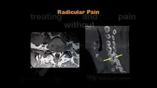 UCSF Radiology: What causes sciatica?