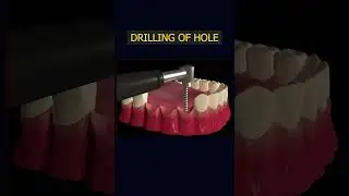 Dental implant 3d animation: #medicalanimation #dentalimplants #medicaleducation