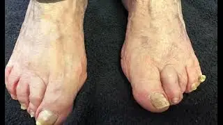 What to expect for a typical nail debridement at a podiatry office?