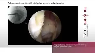 RIWOspine Full-endoscopic Spine Surgery at Lumbar Spine  - interlaminar approach