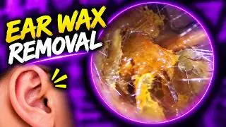 Ear Wax Removal  This Huge Wax Plug Is Satisfying