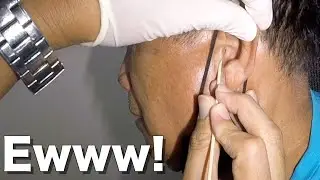 How to Remove Man's STICKY Earwax stuck in His Ear Canal