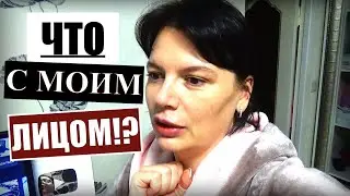 ЧТО СЛУЧИЛОСЬ С МОИМ ЛИЦОМ; ВЛОГ