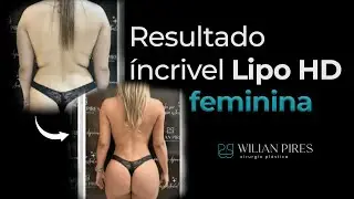 Analisando o resultado incrível de uma Lipo HD feminina | Dr. Wilian Pires
