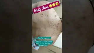Body Acne can be treated | Dermatologist in Chandigarh Punjab | Dr Ashima Goel 