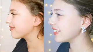 BURUN AMELİYATI SÜRECİM ⎪2 HAFTALIK VLOG 😅