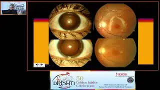 KSOS2023   GP31  Topic Dr Lalit Verma  Key note Address  All is not lost if you act quick in endopht