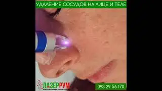Удаление сосудов на лице и теле