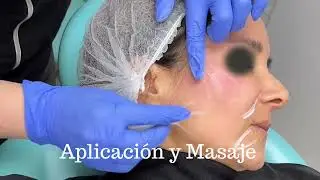 Bioestimulación Híbrida con Synerfill Dra.Tanya Díaz