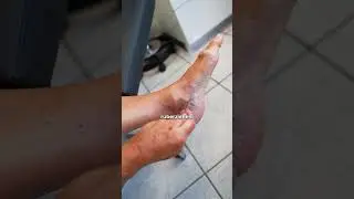 Quick relief for hot 