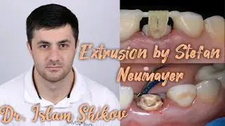Tooth extrusion by Stefan Neumeyer. Dr. Islam Shikov