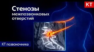 Intervertebral foramina stenosis on CT